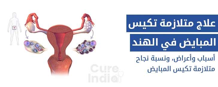 علاج متلازمة تكيس المبايض في الهند